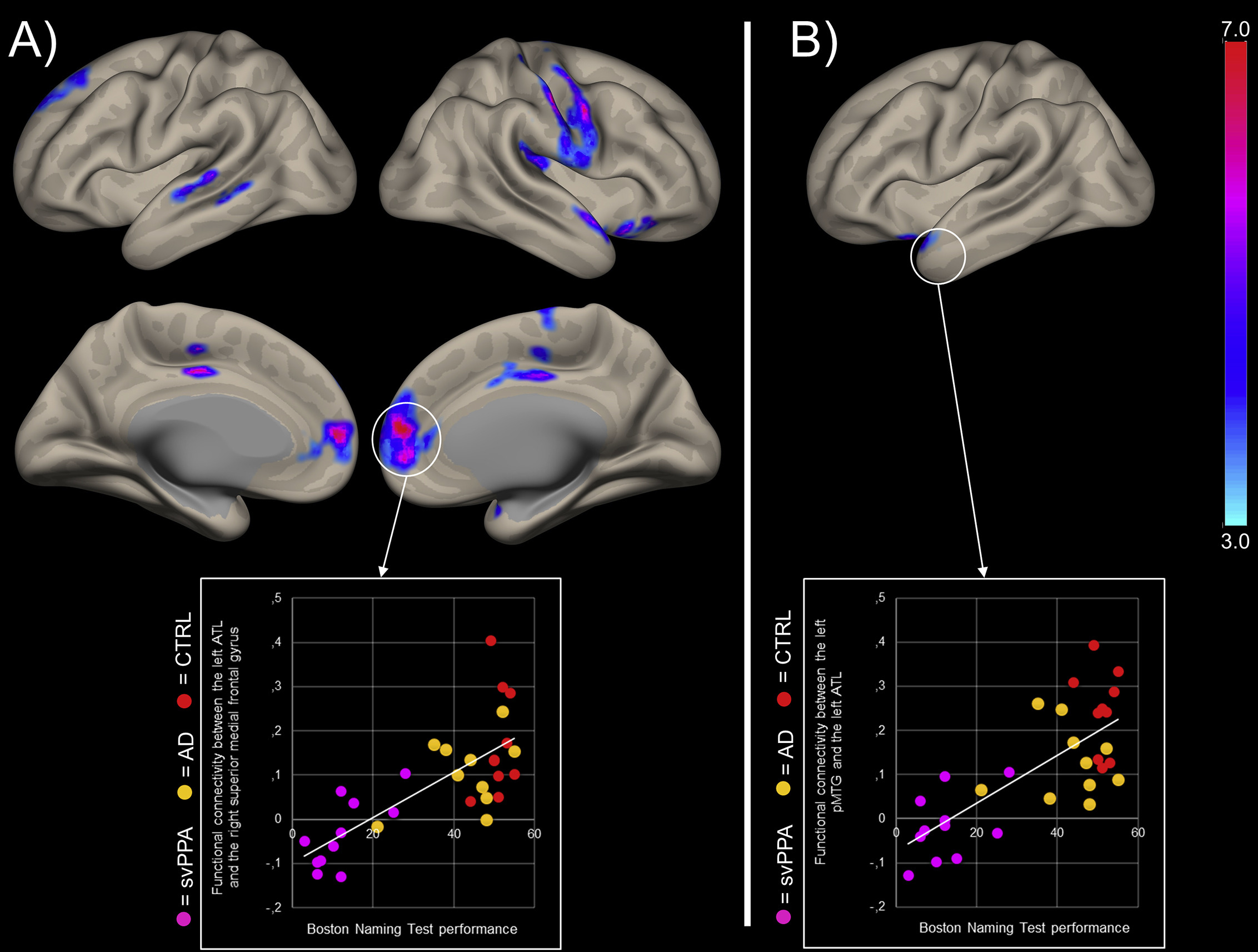 Differential language network functional connectivity alterations in ...